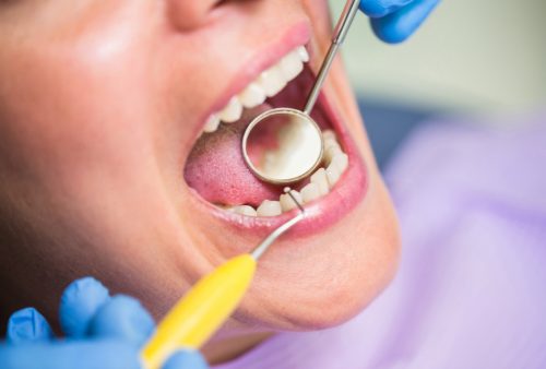 implant dentar
